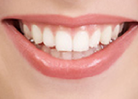 Tooth whitening